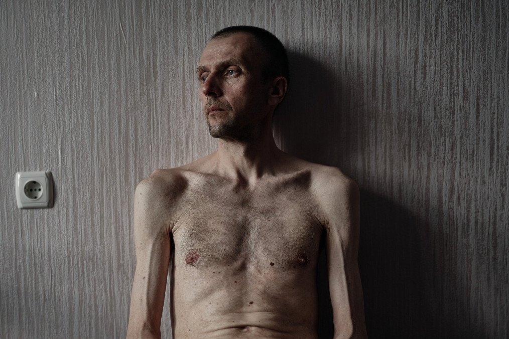 A Ukrainian soldier who was previously held captive poses for a portrait while undergoing rehabilitation on June 6, 2024 in Ukraine. (Source: Getty Images)