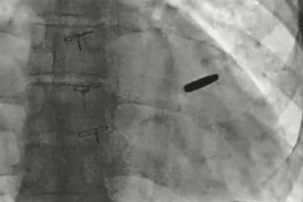 Ukrainian Soldier Survived Mariupol, Captivity—and Three Years With a Bullet in His Heart