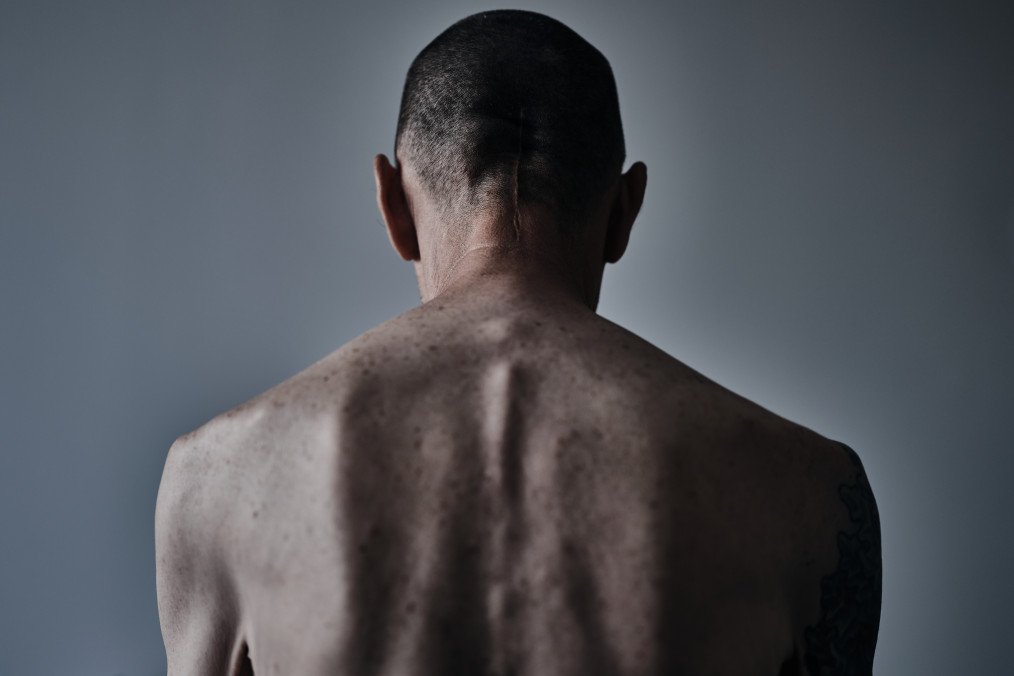 A soldier who has returned from captivity, shows traces of torture, as he undergoes medical examinations and rehabilitation at a state rehabilitation center on September 16, 2024 in the Poltava region, Ukraine. (Source: Getty Images)