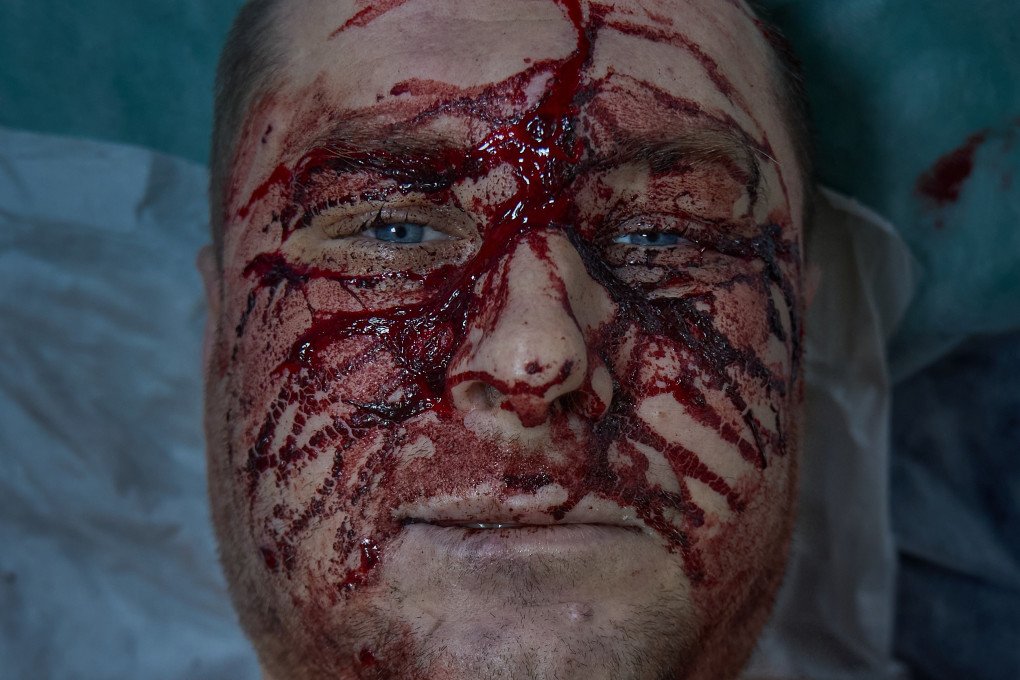 A wounded Ukrainian soldier waiting for an operation in the 3rd Army Corps’ 4th Separate Medical Battalion’s medical block. Photo Mykyta Shandyba/UNITED24 Media. Ukrainian wounded soldier awaiting surgery frontline