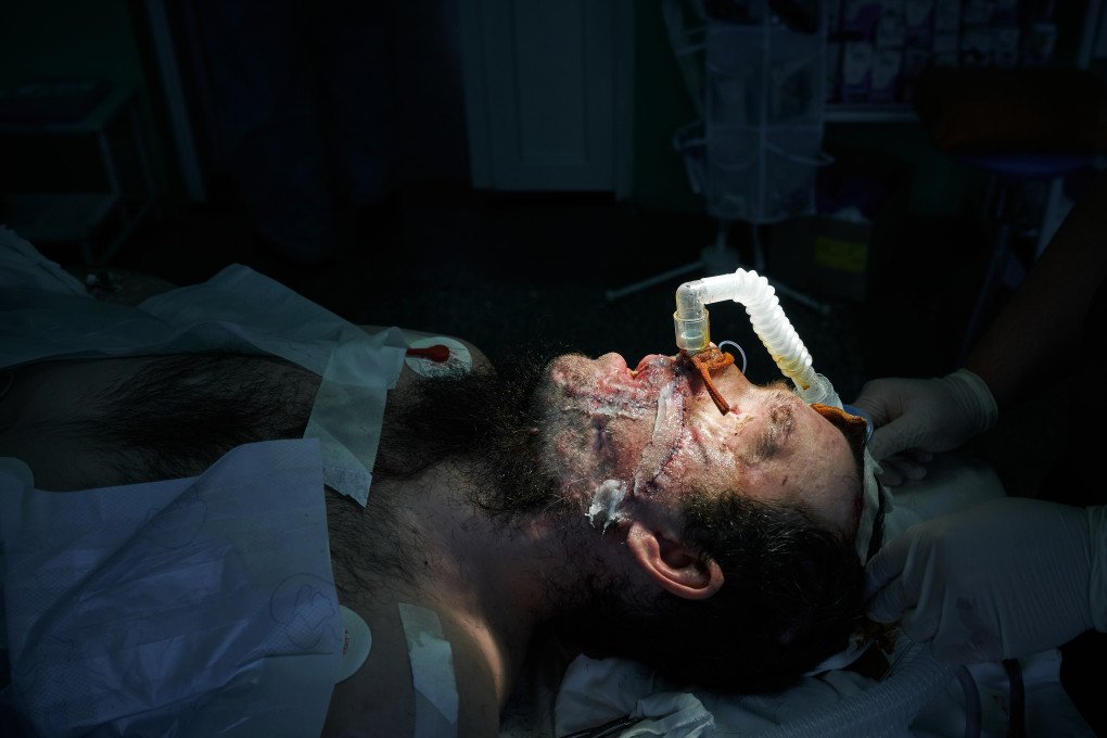 A Ukrainian soldier lies unconscious following reconstructive treatment to restore his face, damaged in combat fighting the Russian invasion. Photo: Josh Olley