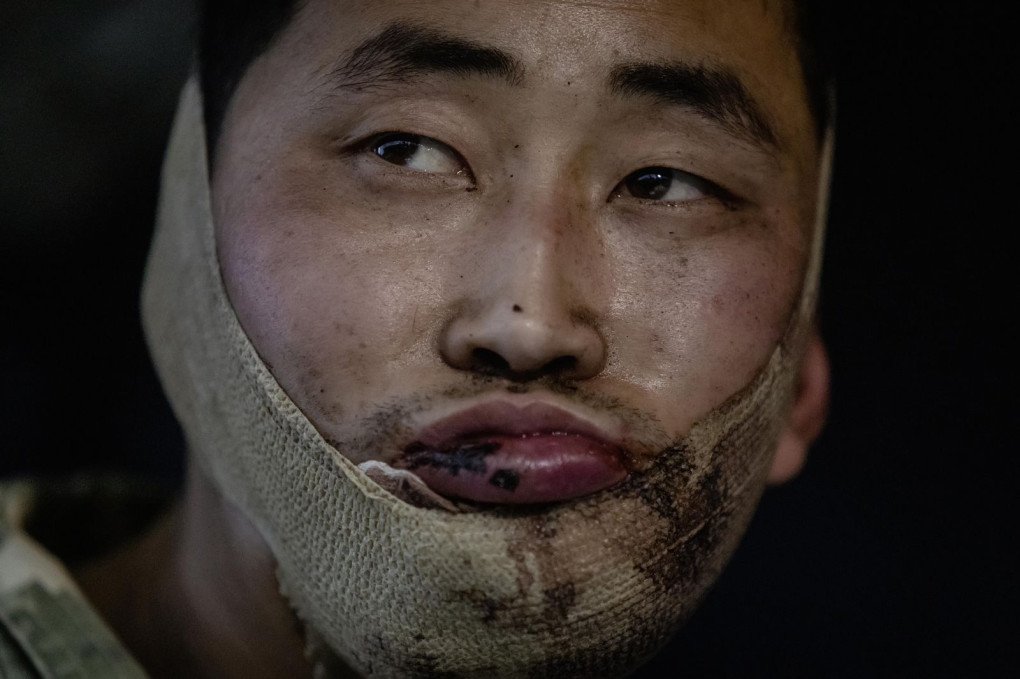 A photo shows an alleged North Korean soldier held after being captured by Ukrainian army on January 11, 2025. (Photo by Ukrainian President Volodymyr Zelenskyy's Social Media / Handout/Anadolu via Getty Images) A photo shows an alleged North Korean soldier held after being captured by Ukrainian army on January 11, 2025. (Photo by Ukrainian President Volodymyr Zelenskyy's Social Media / Handout/Anadolu via Getty Images)