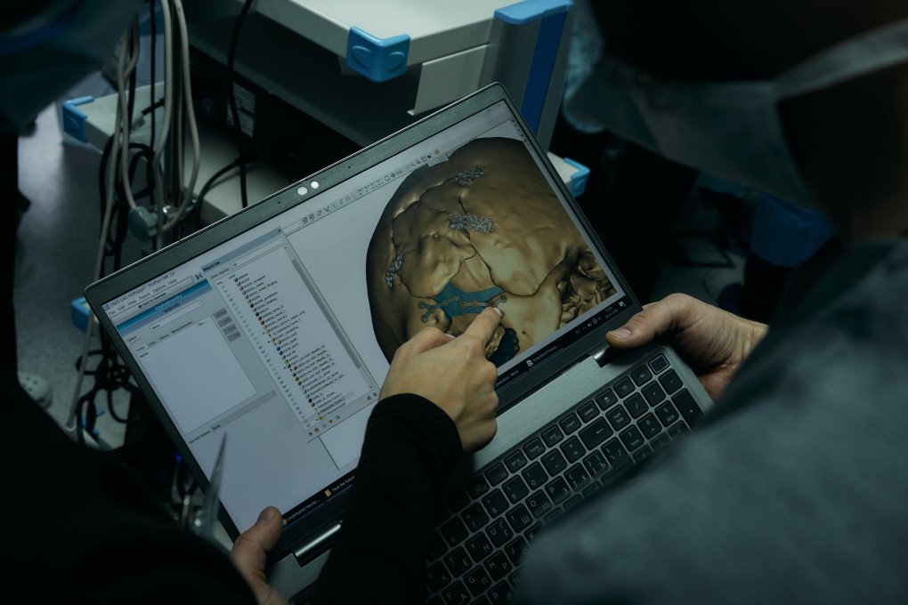 Para esta misión "Enfrenta el Futuro", se necesitaron seis implantes, uno de ellos para Serhii. Foto: Josh Olley/ UNITED24 Media