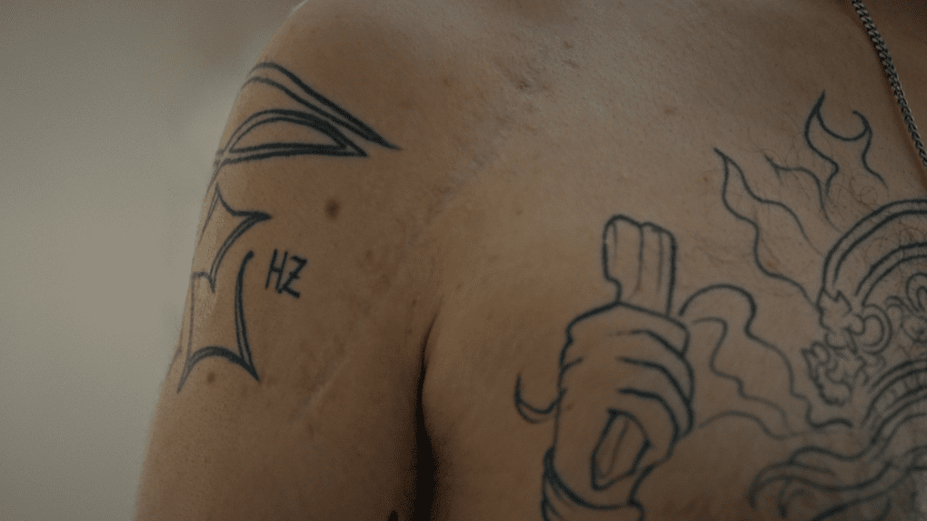 A long surgical scar running across a Arash Darbandi’s chest and shoulder. Photo: UNITED24 Media