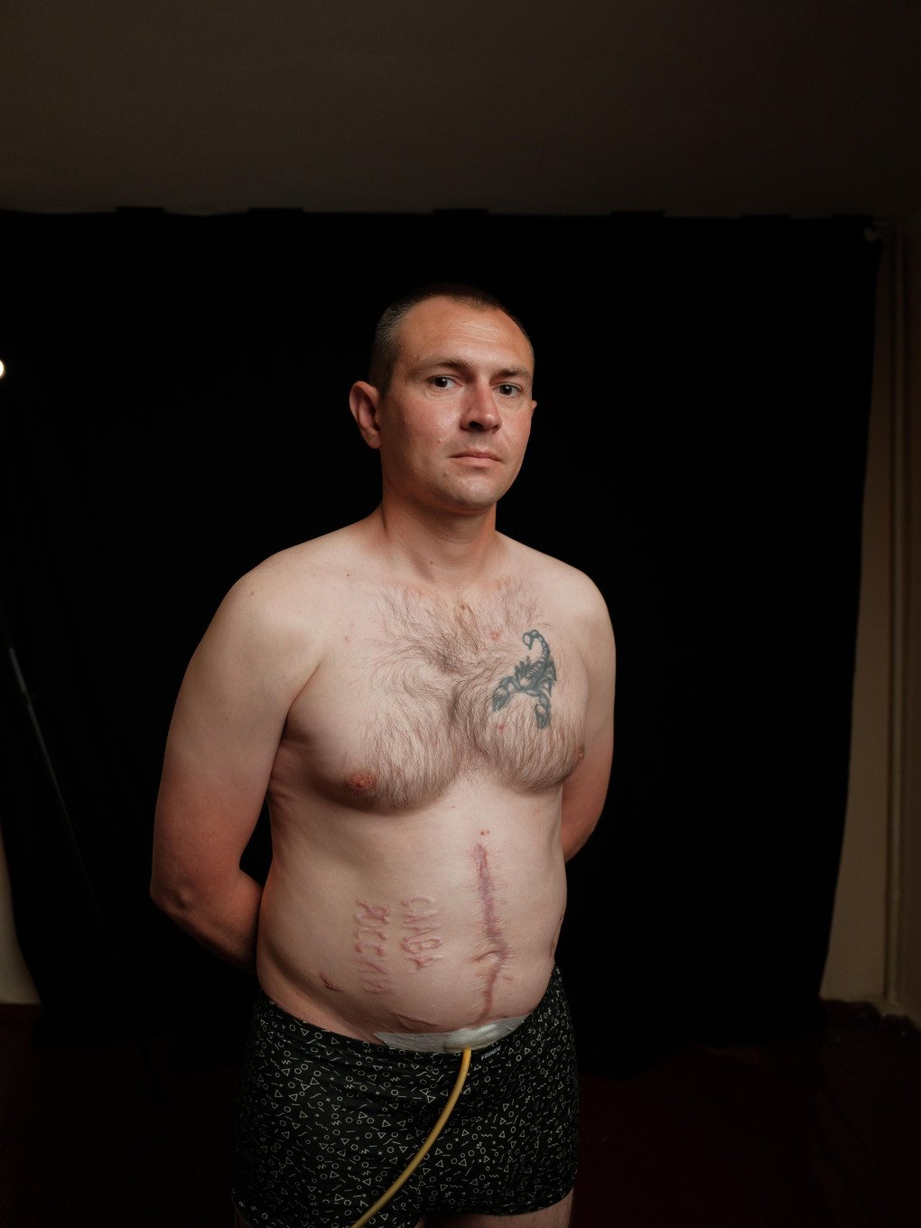 A paratrooper from Ukraine’s 79th Air Assault Brigade, Andrii, with “Glory to Russia” burned into his stomach by a Russian surgeon who operated on him. Photo: Andrii Ovod A paratrooper from Ukraine’s 79th Air Assault Brigade, Andrii, with “Glory to Russia” burned into his stomach by a Russian surgeon who operated on him. Photo: Andrii Ovod