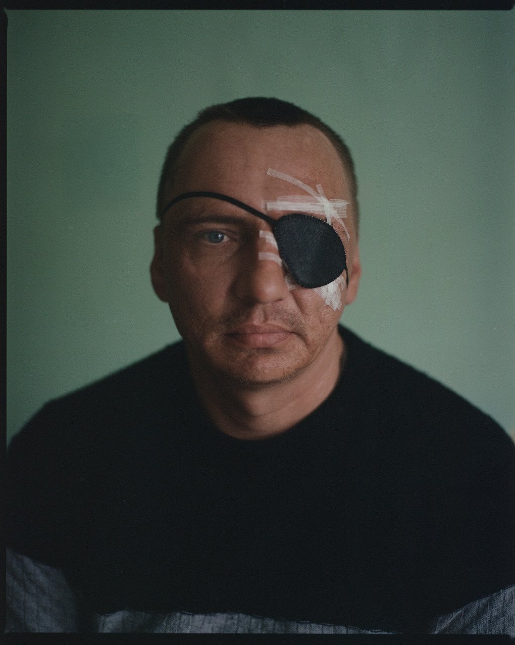 Vasyl was wounded by a bullet during combat. Despite losing an eye, he downplays the injury. “It was not that serious,” he says. Photo: Josh Olley Vasyl was wounded by a bullet during combat. Despite losing an eye, he downplays the injury. “It was not that serious,” he says. Photo: Josh Olley