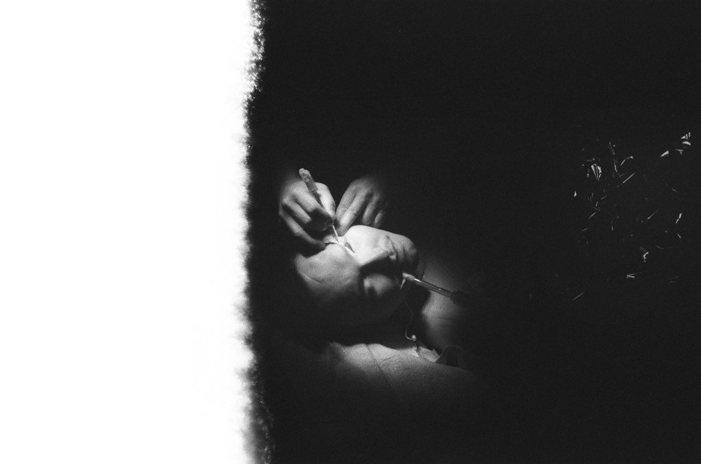 El Dr. Cho explica que muchos de sus pacientes en Ucrania sufrieron lesiones hace tiempo, lo que hace que el trabajo sea cada vez más complejo, sobre todo debido a las cicatrices. Foto: Josh Olley/ UNITED24 Media