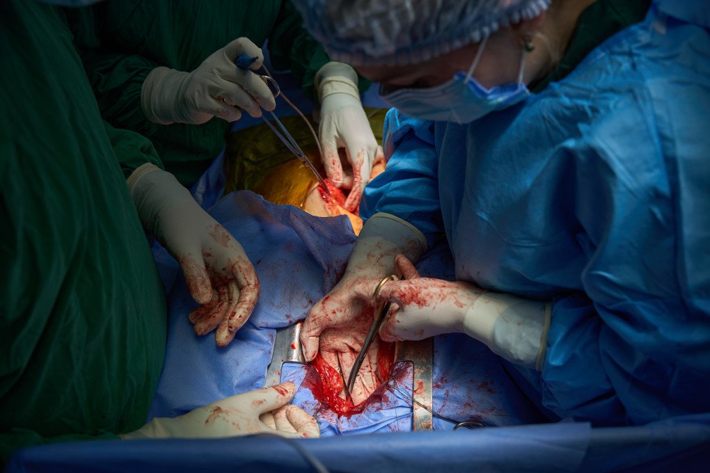 With steady hands and absolute concentration, a Ukrainian surgeon reaches into the thoracic cavity to complete the explant. Using surgical scissors to sever the final connections, the team lifts the heart from the donor's chest. This exact second marks the transition from surgery to logistics; the room's atmosphere shifts immediately as the clock begins ticking down toward the recipient's surgery. (Photo: Mykyta Shandyba / UNITED24 Media) Ukrainian surgeon extracting a donor heart from the chest cavity with surgical scissors during transplant surgery.