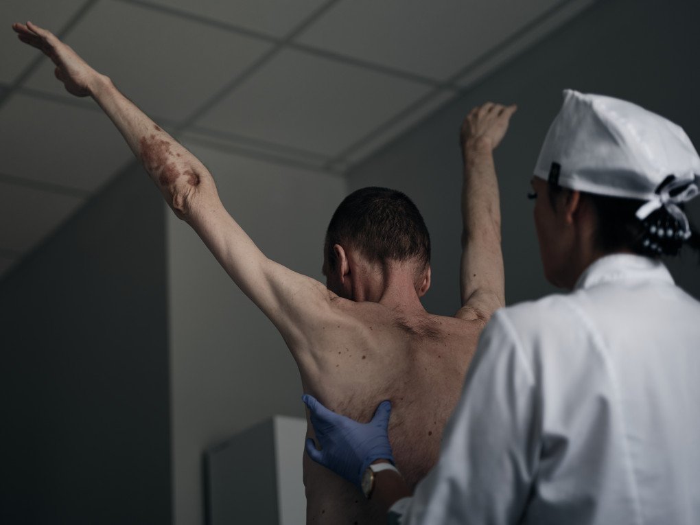 UKRAINE - JUNE 6 2024: A Ukrainian soldier, recently freed from captivity by Russian forces, is examined by medical staff while undergoing rehabilitation at a facility in Ukraine. The soldiers being treated here were among 75 Ukrainians released as part of a prisoner exchange with Russia on May 31. Many of the soldiers endured severe conditions in captivity, losing significant weight. By the time these photos were taken, each had regained approximately 10 kilograms, marking a step forward in their recovery journey. (Photo by Kostiantyn Liberov/Libkos/Getty Images)