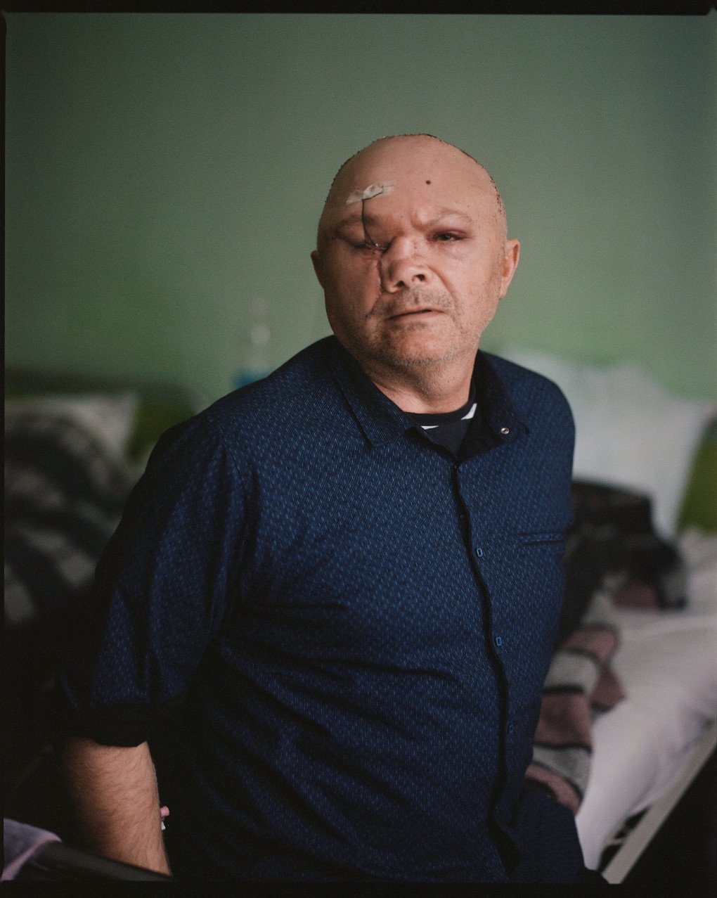 Ivan sits at the edge of his bed, just hours after his fourth surgery. He lost an eye and part of his nose in a mine explosion while defending the Pokrovsk direction in July 2024. Kyiv, May 2025. Photo: Josh Olley/UNITED24 Media. Ivan sits at the edge of his bed, just hours after his fourth surgery. He lost an eye and part of his nose in a mine explosion while defending the Pokrovsk direction in July 2024. Kyiv, May 2025. Photo: Josh Olley/UNITED24 Media.
