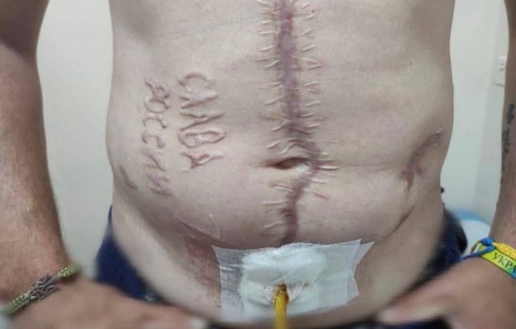 A Ukrainian soldier, recently returned from Russian captivity, shows extensive scarring across his abdomen, including the mutilated phrase “СЛАВА РОССИИ” (“Glory to Russia”) carved into his skin. The image, verified by Ukrainian military intelligence, was taken by a doctor during post-release medical examination. (Source: Clash Report) A Ukrainian soldier, recently returned from Russian captivity, shows extensive scarring across his abdomen, including the mutilated phrase “СЛАВА РОССИИ” (“Glory to Russia”) carved into his skin. The image, verified by Ukrainian military intelligence, was taken by a doctor during post-release medical examination. (Source: Clash Report)