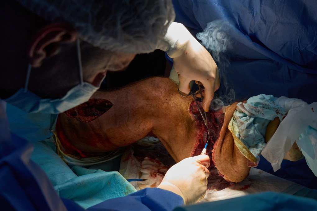 Surgeons from the 3rd Army Corps’ 4th Separate Medical Battalion cauterize muscles on an exploded leg. Photo Mykyta Shandyba/UNITED24 Media Ukraine's frontline surgeons cauterizing wound