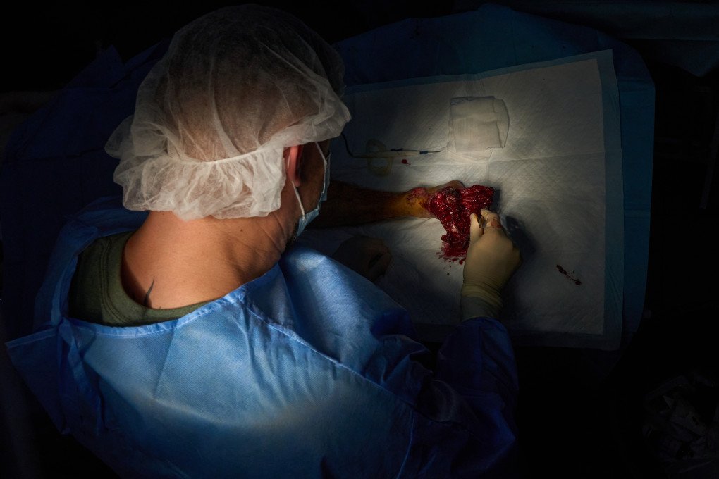 Surgeons from the 3rd Army Corps’ 4th Separate Medical Battalion operate on a wounded foot. Photo Mykyta Shandyba/UNITED24 Media Soldier foot surgery in frontline Ukraine