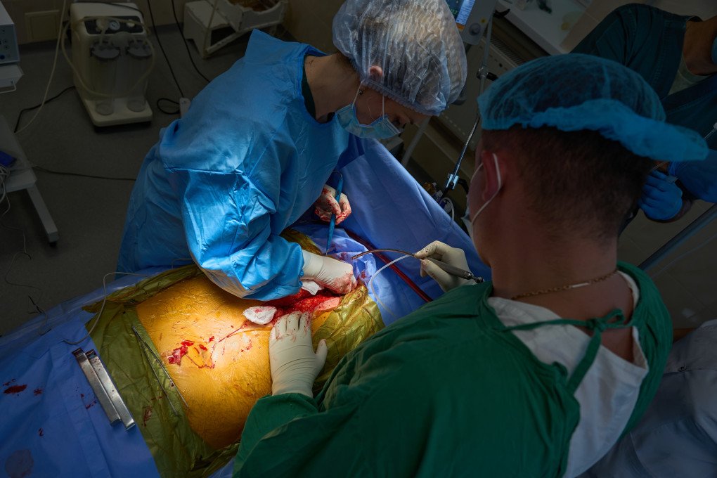 From above, the carefully orchestrated choreography of the operating room comes into full view. While one surgeon utilizes an electric scalpel to carefully navigate the tissue, their colleague manages suction to maintain a clear field of vision. Every piece of equipment in this room—from the specialized surgical tools to the vital monitoring systems—must be kept powered and functional, making the stability of Ukraine's medical infrastructure a silent, crucial partner in every life saved. (Photo: Mykyta Shandyba / UNITED24 Media) Overhead view of Ukrainian surgeons operating on a patient's thoracic cavity during a donor organ harvest surgery in a hospital.