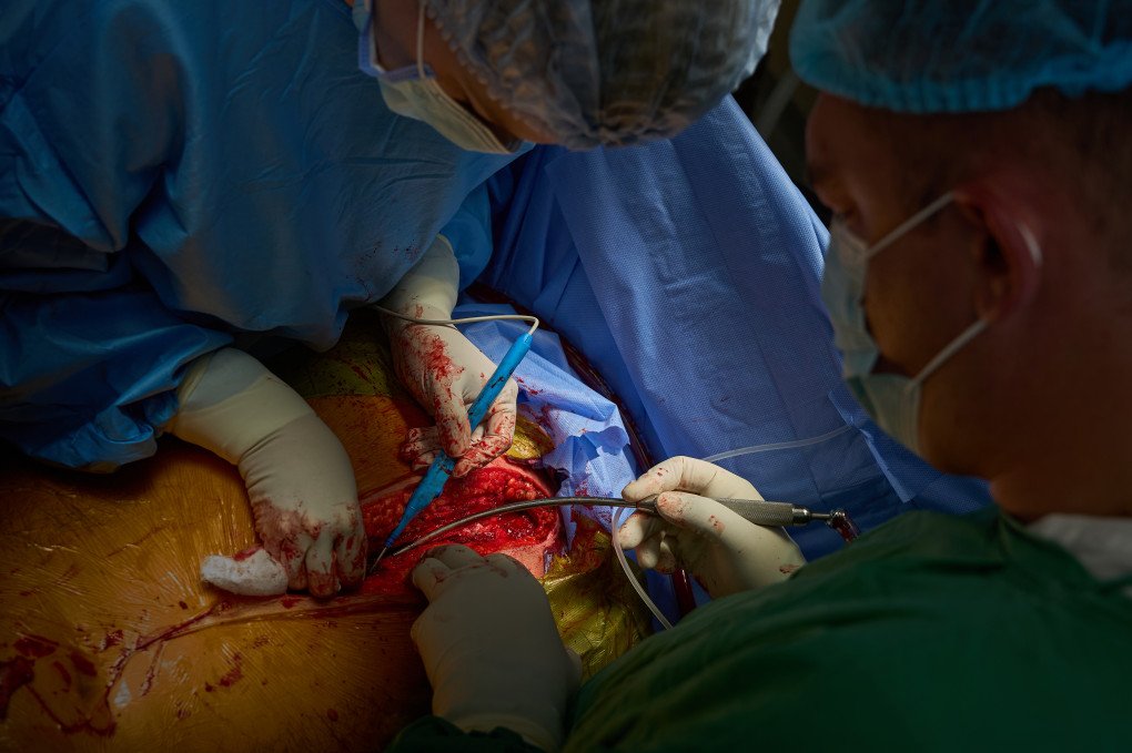 A striking close-up inside the incision reveals the absolute precision required in the operating theater. Working methodically with cautery and suction tools, the surgical team navigates the thoracic cavity to isolate the donor heart. In wartime Ukraine, medical professionals have had to perfect this level of intense focus, blocking out the external anxieties of war to ensure that not a single millimeter of tissue is compromised during the extraction phase. (Photo: Mykyta Shandyba / UNITED24 Media) Close-up of Ukrainian surgeons using a medical cautery tool and suction during a complex open-chest heart explant surgery.