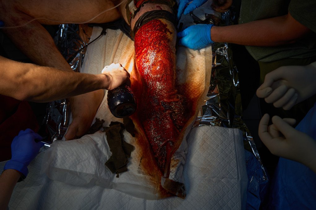Surgeons from the 3rd Army Corps’ 4th Separate Medical Battalion cauterize muscles on an exploded leg. Photo Mykyta Shandyba/UNITED24 Media Ukraine's Frontline surgeons cauterizing leg
