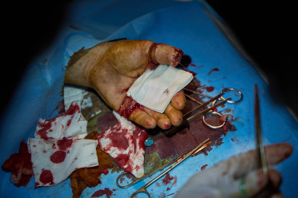 Surgeons from the 3rd Army Corps’ 4th Separate Medical Battalion cauterize muscles on a cut finger. Photo Mykyta Shandyba/UNITED24 Media Ukraine's Frontline surgeons treating finger