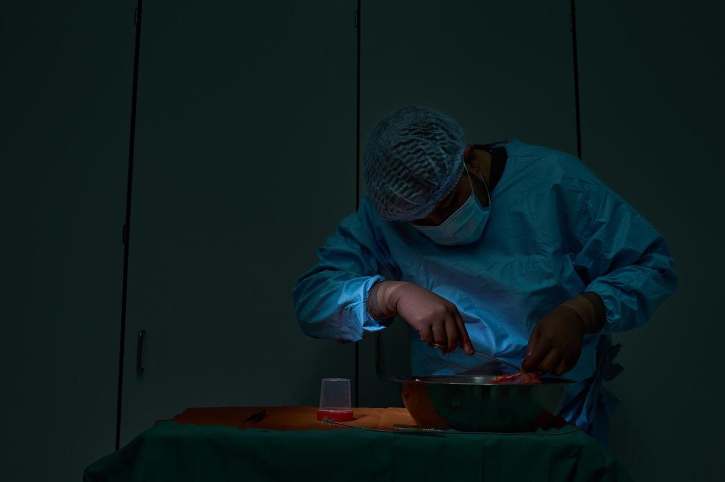 Standing just a few feet from where Dr. Todurov and his team are implanting the new donor heart, another medical professional meticulously dissecting the excised, diseased heart. Under a focused spotlight, this work is crucial. As the transplant is occurring a few feet away, this professional gathers tissue for immediate pathological assessment, providing data to understand the failure of the old organ while the new one takes its place. (Photo: Mykyta Shandyba / UNITED24 Media) A medical professional in surgical attire dissecting a tissue sample from a failed heart in a dimly lit hospital room.