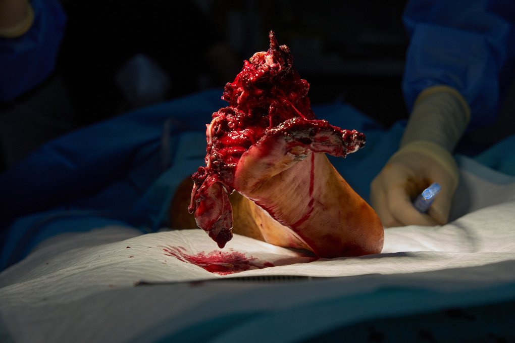 Surgeons from the 3rd Army Corps’ 4th Separate Medical Battalion operate on an exploded foot. Photo Mykyta Shandyba/UNITED24 Media Wartime amputation surgery in Ukraine