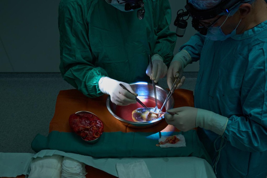 Standing just a few feet from where Dr. Todurov and his team are implanting the new donor heart, another medical professional meticulously dissecting the excised, diseased heart. Under a focused spotlight, this work is crucial. As the transplant is occurring a few feet away, this professional gathers tissue for immediate pathological assessment, providing data to understand the failure of the old organ while the new one takes its place. (Photo: Mykyta Shandyba / UNITED24 Media) A medical professional in surgical attire dissecting a tissue sample from a failed heart in a dimly lit hospital room.
