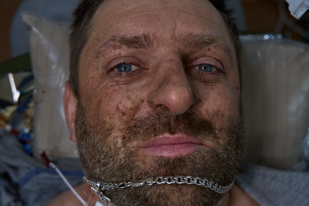 A wounded Ukrainian soldier waiting for an operation in the 3rd Army Corps’ 4th Separate Medical Battalion’s medical block. Photo Mykyta Shandyba/UNITED24 Media. Ukrainian wounded soldier awaiting surgery frontline