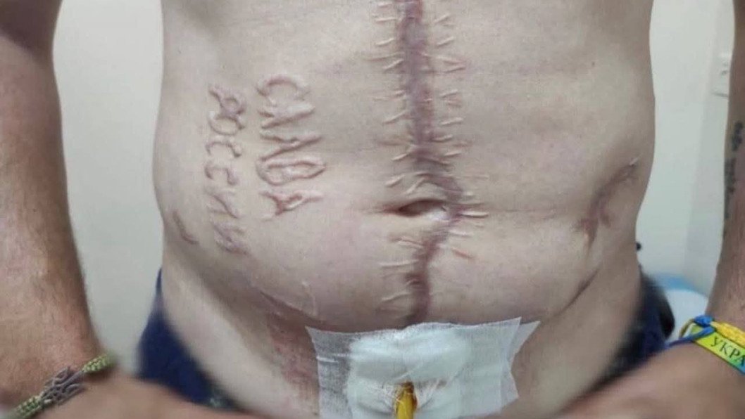 “Glory to Russia” Carved Into Ukrainian POW: Torture Photo Confirmed as Authentic
