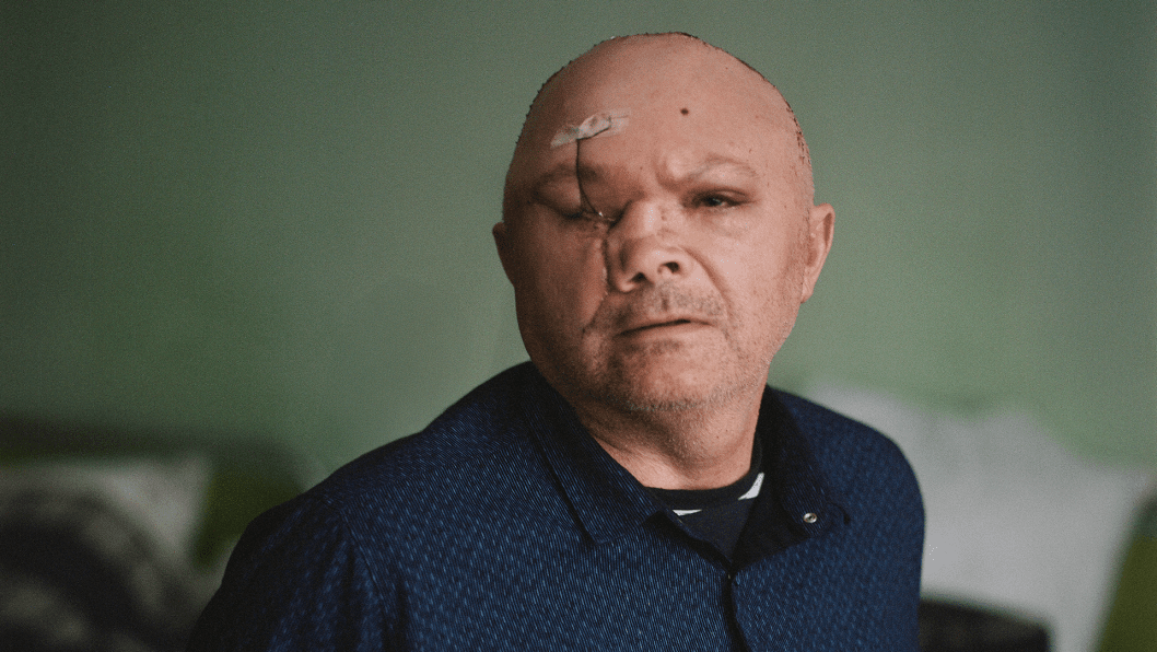 Russia Shatters Their Faces on the Frontline. These American Doctors Reconstruct Them