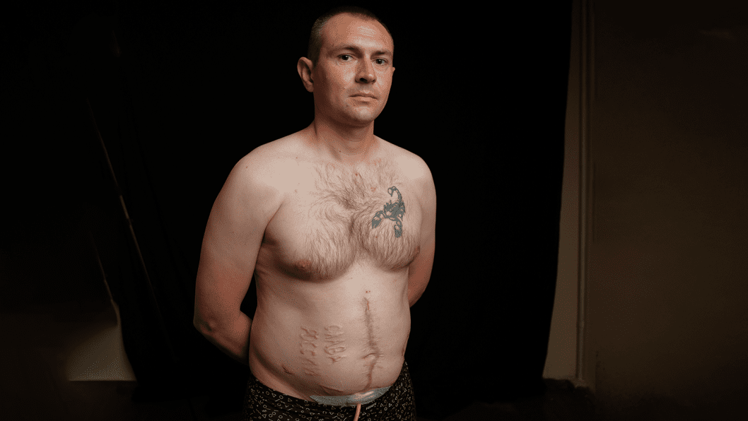 “They Burned ‘Glory to Russia’ Into My Stomach”: Ukrainian Soldier’s First Interview After Torture in Russian Captivity