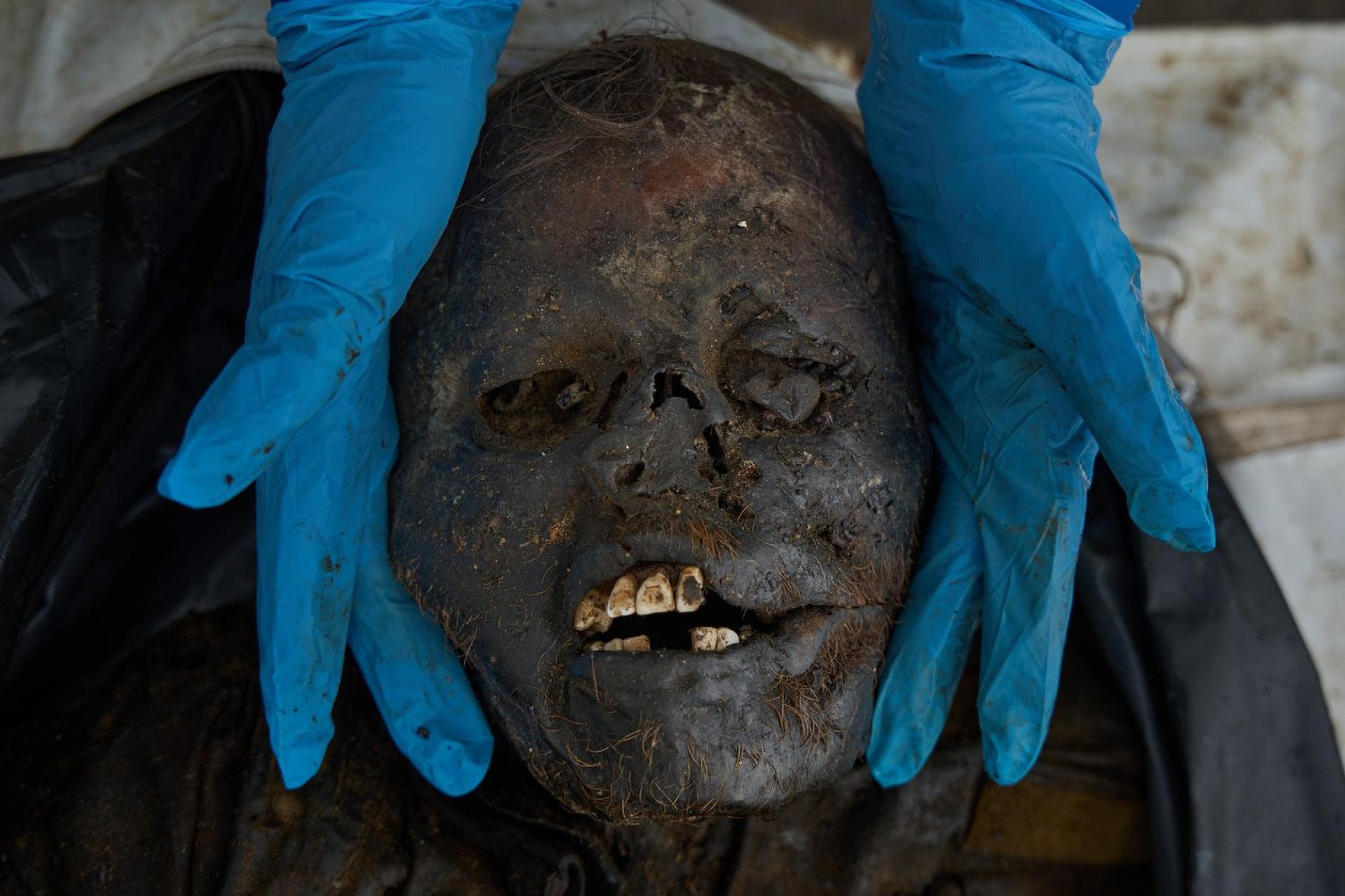 A close-up, high-angle overhead photograph shows a forensic expert wearing bright blue nitrile gloves gently holding the decomposed, mummified head of a casualty. The skin of the face is deeply blackened, leathery, and covered in dirt, leaving the teeth exposed through the open mouth. Strands of light brown or strawberry blonde hair are visible on the top of the head and along the jawline, serving as a distinct physical identifier during the forensic examination.