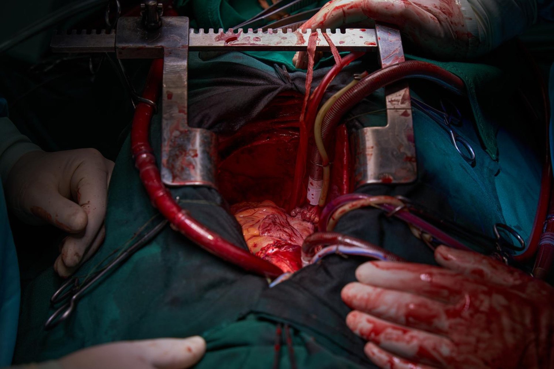 The stark void of transition is gone, replaced by the healthy tissue of the donor heart. Nestled deep within the pericardial cavity, the organ has been meticulously sutured to the patient's major blood vessels. While the cardiopulmonary bypass tubes remain attached for the moment, the stage is now set for the most dramatic climax of the entire operation: removing the clamps, allowing the patient's blood to flood the new tissue, and waiting for the first autonomous beat. (Photo: Mykyta Shandyba / UNITED24 Media) A donor heart successfully sutured into a recipient's chest cavity during a transplant surgery at a Kyiv hospital.