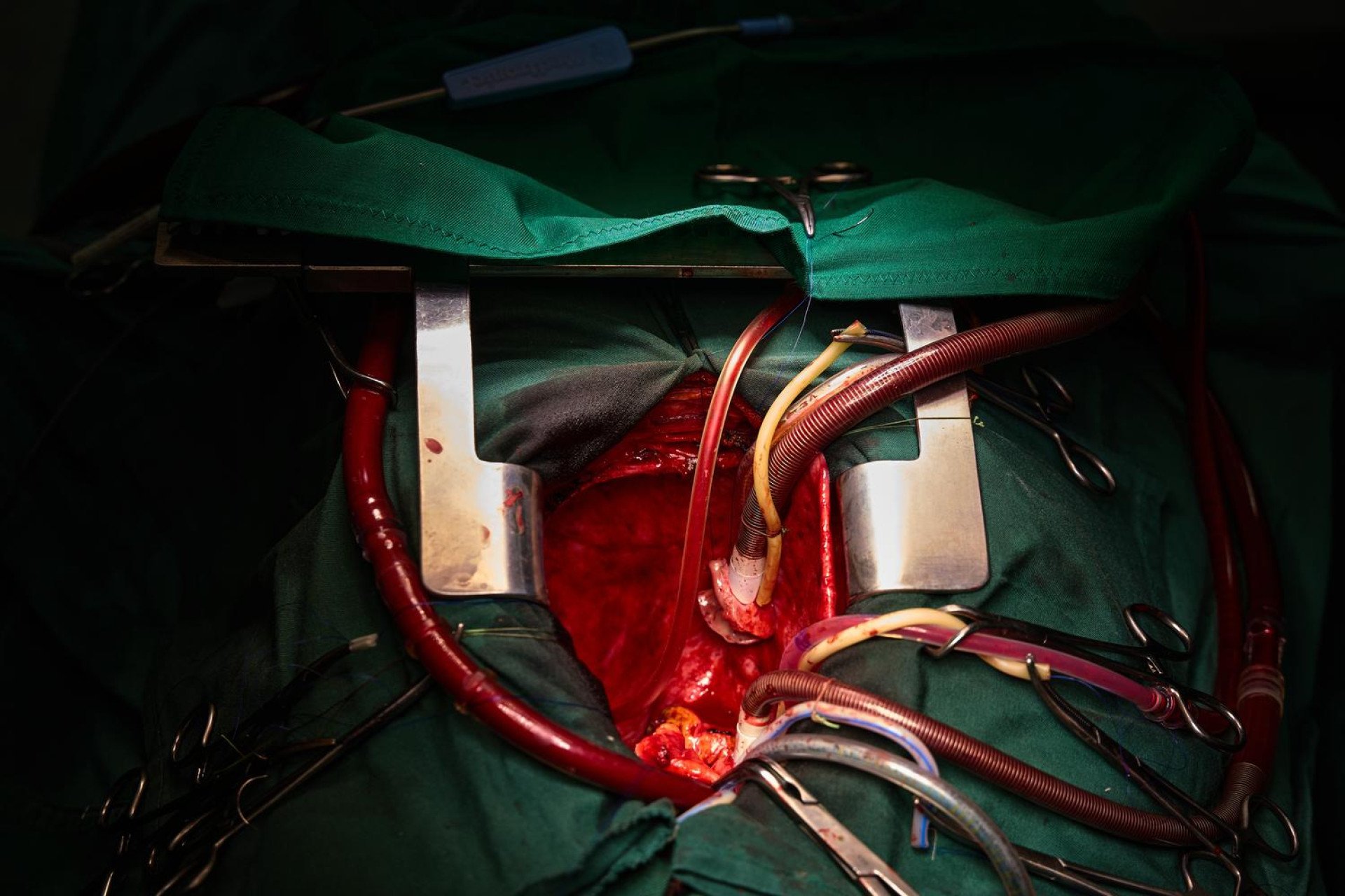 A rare and striking look inside the recipient’s open chest cavity reveals an eerie stillness just moments before the donor organ arrives. The failing heart has been removed, leaving a void where life usually beats. Thick bypass tubes snake into the cavity, carrying oxygenated blood throughout the patient's body to keep them alive mechanically—a tense, mid-surgical limbo that pushes the boundaries of medical science in the heart of Kyiv. (Photo: Mykyta Shandyba / UNITED24 Media) An empty pericardial cavity during a heart transplant surgery with cardiopulmonary bypass tubing maintaining life support.