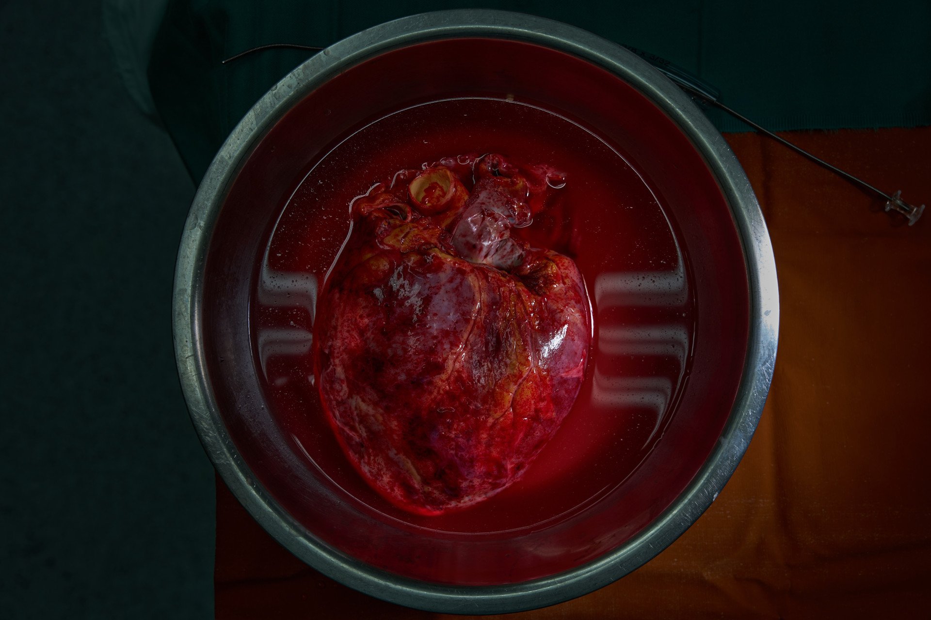 Inside Ukraine’s Wartime Race to Transplant Organs & Save Lives A medical cooler containing a donor organ being rushed through a hospital corridor by Ukrainian medical staff.