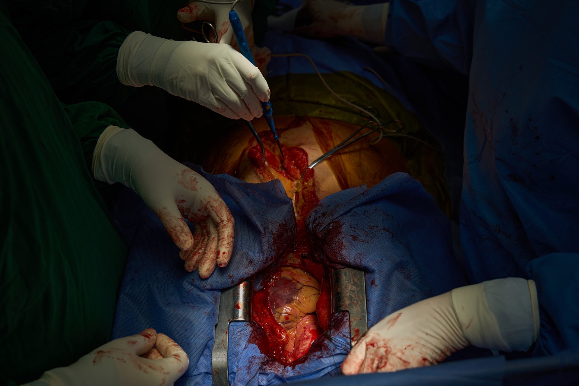 Held open by a sternal retractor, the donor heart is fully visible just moments before explantation. Surrounded by the steady hands of Ukrainian surgeons, this organ represents a profound transition from tragedy to survival. The medical team works with seamless coordination to clamp the major vessels, halting the heart before placing it into a specialized preservation solution to begin its rapid, life-saving journey to the city of Kyiv. (Photo: Mykyta Shandyba / UNITED24 Media) A donor heart exposed inside the chest cavity using a sternal retractor during a transplant surgery in Ukraine.