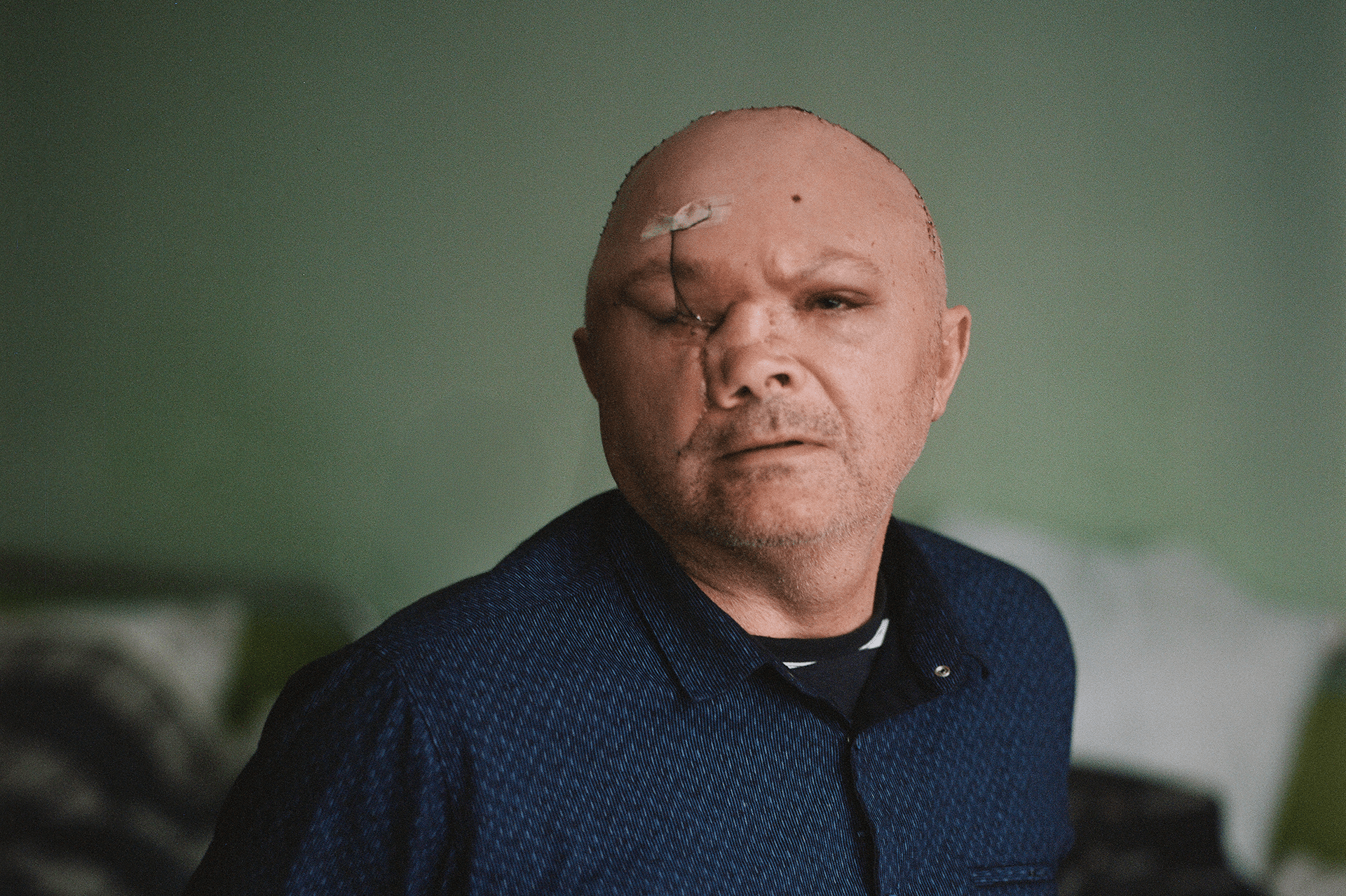Ukrainian soldier Ivan after facial reconstruction surgery Ukrainian Soldiers Undergo Facial Reconstruction Surgery After Russian Attacks