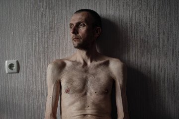 A Ukrainian soldier who was previously held captive poses for a portrait while undergoing rehabilitation on June 6, 2024 in Ukraine. (Source: Getty Images)