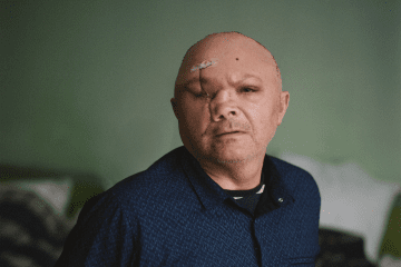 Ukrainian Soldiers Undergo Facial Reconstruction Surgery After Russian Attacks