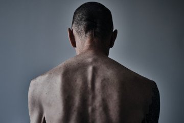 A soldier who has returned from captivity, shows traces of torture, as he undergoes medical examinations and rehabilitation at a state rehabilitation center on September 16, 2024 in the Poltava region, Ukraine. (Source: Getty Images)