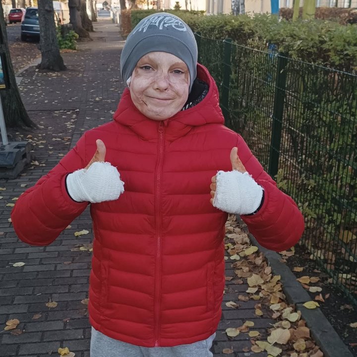 Eight-year-old Roman Oleksiv, who sustained burns to 45% of his body from a Russian missile strike on Vinnytsia in July 2022, took off his scar-reducing mask, December, 2024. (Source: yaroslavoleksiv / Instagram) Eight-year-old Roman Oleksiv, who sustained burns to 45% of his body from a Russian missile strike on Vinnytsia in July 2022, took off his scar-reducing mask, December, 2024. (Source: yaroslavoleksiv / Instagram)
