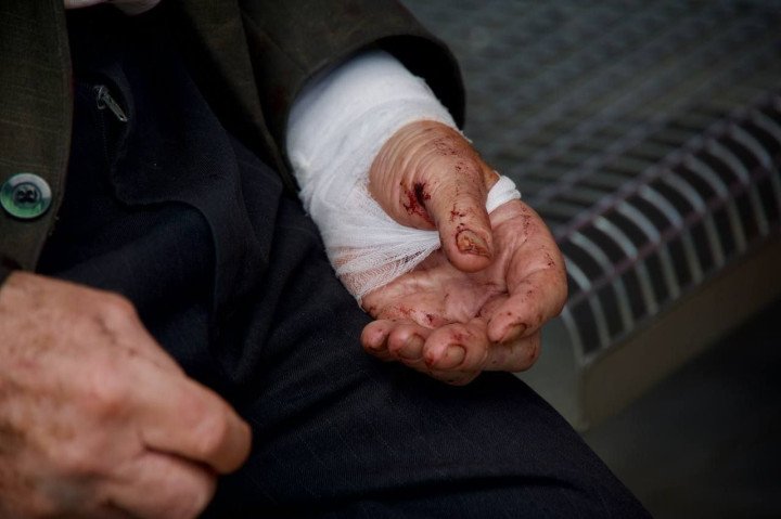 An injured man after Russia’s attack on Dnipro, July 3, 2024. (Source: Dnipropetrovsk Regional State Administration) An injured man after Russia’s attack on Dnipro, July 3, 2024. (Source: Dnipropetrovsk Regional State Administration)