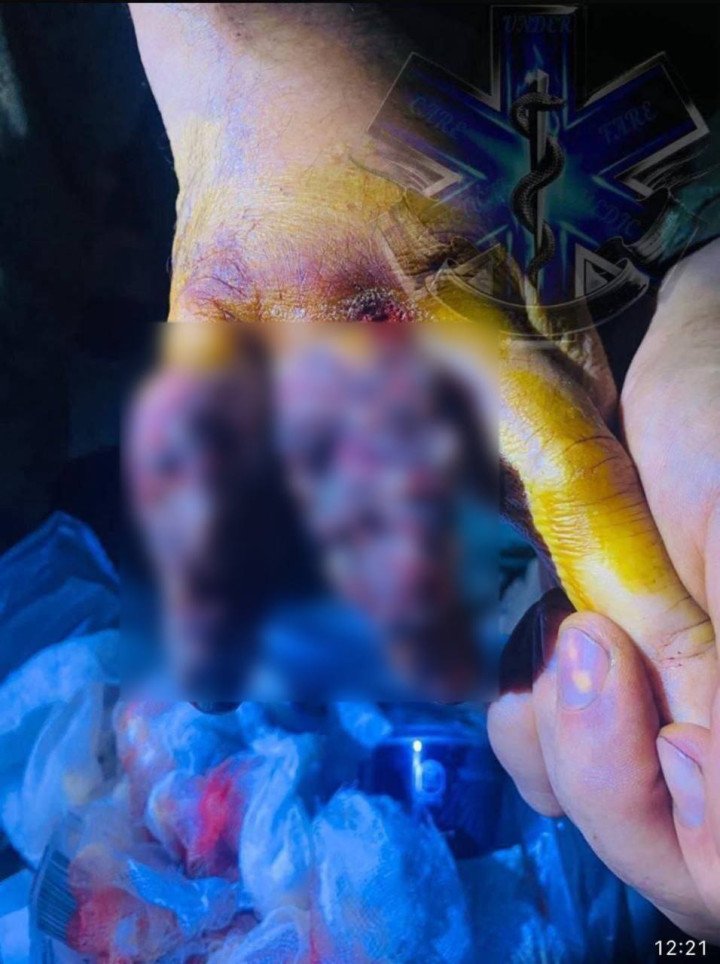The photo depicts the hand of a Ukrainian soldier with severe chemical burns caused by the use of chemical weapons by Russian Forces. (Source: Yurii Fedorenko) The photo depicts the hand of a Ukrainian soldier with severe chemical burns caused by the use of chemical weapons by Russian Forces. (Source: Yurii Fedorenko)